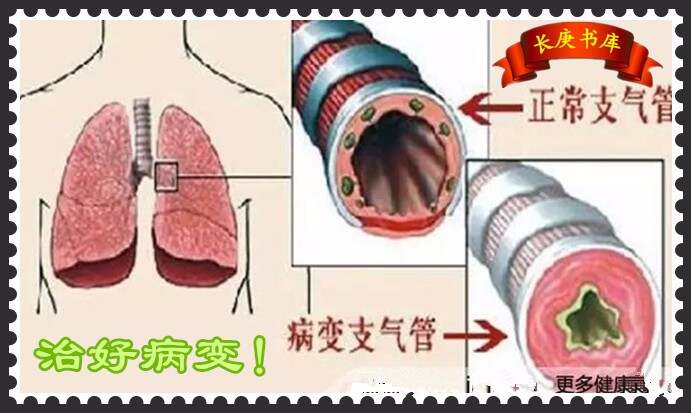 支气管扩张最新治疗策略与方案