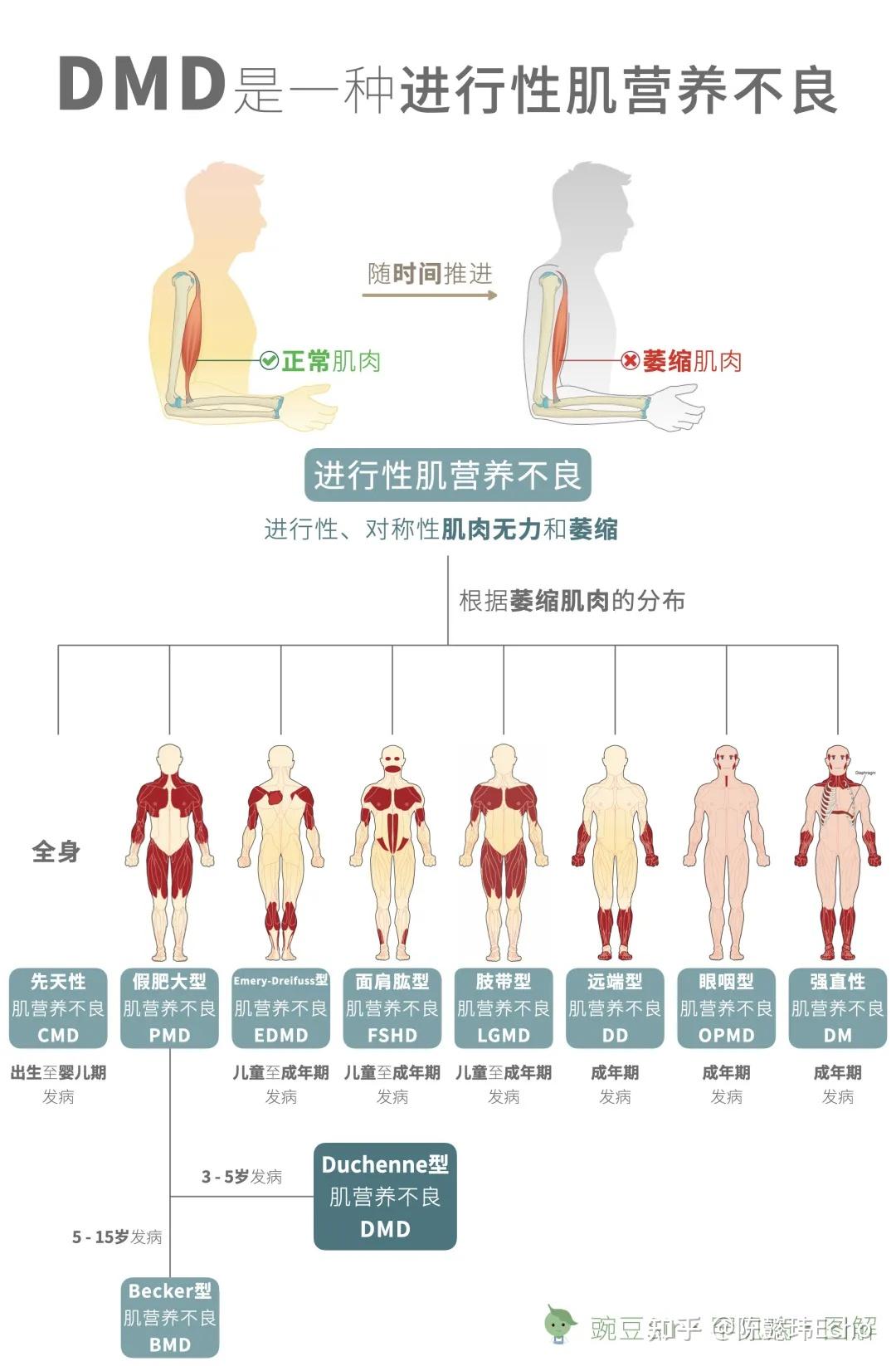 肌营养不良药物治疗最新进展研究概述